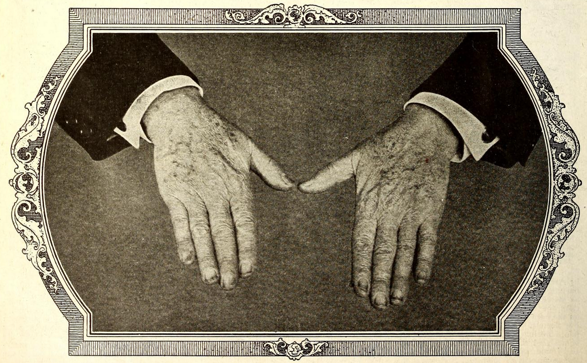 The Only Authentic Photograph of Mr. Edison's Hands Ever Taken Publisht Here for the First Time. The Spots on the Hands Are Chemical Stains Which Could Not Be Washt off at the Time the Picture Was Taken. IF THE WORLD WERE CALLED UPON TO MAKE AN INVENTORY OF WHAT MR. EDISON'S HANDS ACTUALLY WROUGHT IN ENRICHING THIS PLANET, THERE WOULD NOT BE GOLD ENOUGH TO PAY HIM.
